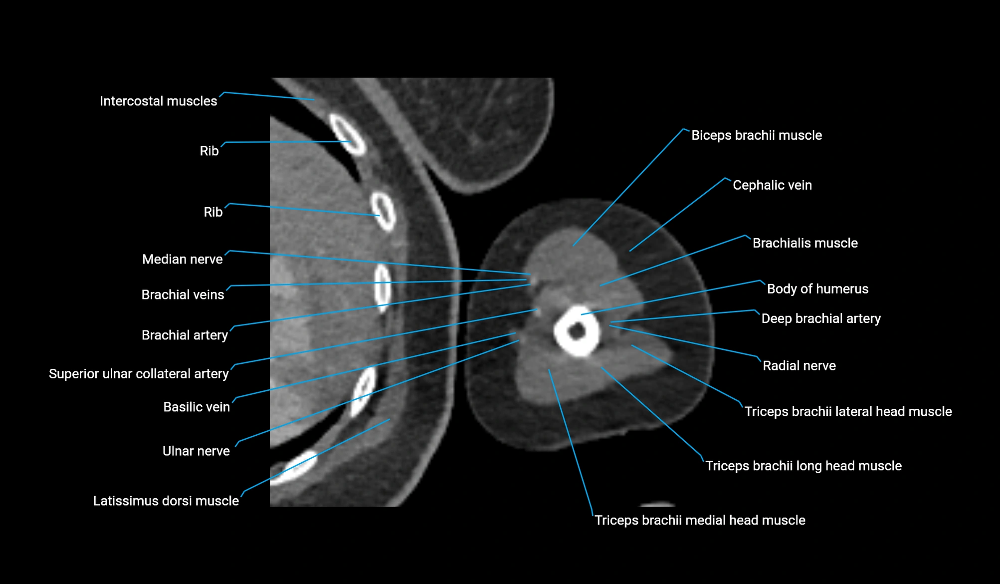 CT upper arm axial  cross sectional anatomy labelled radiology image -00282.webp